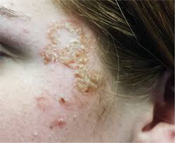Herpes simplex virus is categorized into 2 types: Is It Ringworm Herpes Or Something Else Entirely Clinician Reviews