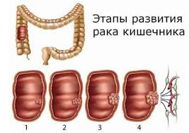 Rak Kishechnika Prichiny Vozniknoveniya Stadii I Formy Zabolevaniya Pervye Priznaki I Simptomy Osobennosti Diagnostiki I Metody Lecheniya Prognoz Dlya Zhizni