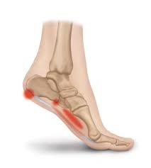 Get superior comfort & revolutionary support. The Consequences Of Leaving Plantar Fasciitis Untreated Heel That Pain