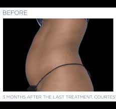 Emsculpt machine for sale is popular in salon and clinic. Emsculpt Neo S Thetics