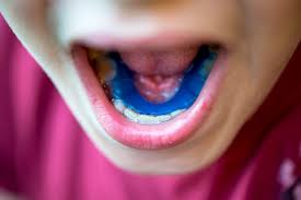 See full list on charlestonorthodonticspecialists.com How To Prevent Teeth Shifting After Braces