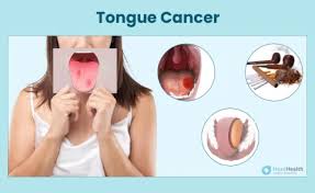 Image result for cancer tongue symptoms)