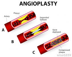 An item used to identify something or someone, as a small piece of paper or cloth attached to an article to designate its origin, owner, contents. What Is A Coronary Artery Blockage With Pictures