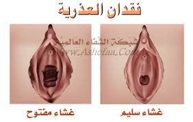 انواع غشاء البكارة شبكة الشفاء العالمية