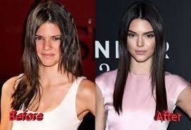 Although she denies having undergone plastic surgery, kendall jenner surgery transformation has received very positive reviews. Kendall Jenner S Before And After Photos Show That She Didn T Undergo Major Surgery Aedsys