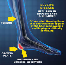 Image result for Calcaneal Apophysitis