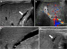 Introduction • biliary atresia is characterized by obliteration or discontinuity of the extrahepatic biliary system, resulting in obstruction to bile flow. Practical Approach To Imaging Diagnosis Of Biliary Atresia Part 1 Prenatal Ultrasound And Magnetic Resonance Imaging And Postnatal Ultrasound Springerlink