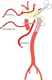 Massage on your lower body for patients with lower body lymphedema who have had treatment for cancer which included: Cannulation For Simultaneous Perfusion Of Heart Brain And Lower Body Download Scientific Diagram
