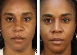 Pin On Rhinoplasty Procedures