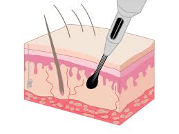 Custom tattoo design wants to ensure every customer gets exactly what they're looking for. Australia S Science Channel Skin Deep Science How Do Tattoos Work