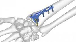 Acu-Loc Wrist Plating System | Acumed