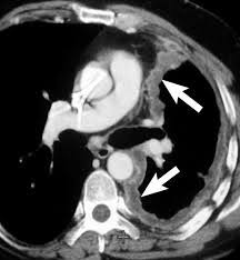 Most typical ct findings of mpm are unilateral pleural effusion,. Mesothelioma Oncology Medbullets Step 2 3