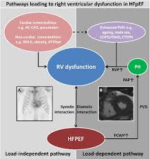 Image result for Right Heart Failure