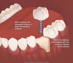 Losing baby teeth is a rite of passage for children. Bone Grafting