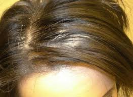 Lime and black pepper seeds seeds of lime and black pepper, when ground finely and applied on the scalp, prove to be a very good cure for averting hair loss. Indian Home Treatment Hair Loss Treatments Just What Works And What Won T Home Remedies Hair