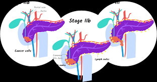 Amin mb, edge s, greene f, byrd dr, brookland rk, et al, eds. Stages Of Pancreatic Cancer Managing Pancreatic Cancer Let S Win