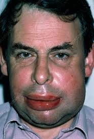 Image result for Angioedema