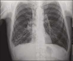 Image result for Sinus X Ray