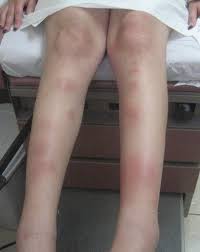 Image result for erythema nodosum