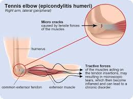 Tenocytes constantly repair small amounts of damage to the matrix under normal circumstances; 5 Elbow Overuse Injuries That Is Preventing You From Doing The Things You Love To Do Tennis Elbow Elbow Braces Tennis Elbow Treatment
