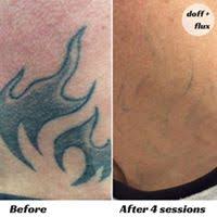Many women have asked me, can i get a tattoo while breastfeeding? Is It Safe To Undergo Laser Tattoo Removal While Pregnancy Breastfeeding Doff Flux