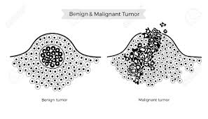 Optimal treatment often demands the combined skills of an . Vector Isolated Illustration Of Malignant And Benign Tumor In Healthy Tissue Spreading Of Cancer Cells Tumor Development Medical Infographics For Poster Educational Science And Medical Use Royalty Free Cliparts Vectors And Stock