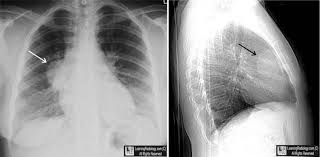 Thymoma Radiology Medical Imaging Tumor
