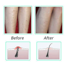 They grow back into the hair follicle in the skin. Exfoliating Shower Brush Hair Massage Comb Scalp Massager Ingrown Hair And Razor Bump Treatment Body Scrub Tool For Man Woman Massage Comb Aliexpress