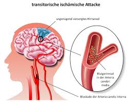 Transitorisch wirtschaft/volkswirtschaft | commercial term, commercewirtsch. Transitorische Ischamische Attacke Behandlung