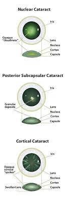 Image Result For Eye Cataract Types Eye Cataract Eye Facts Eye Anatomy