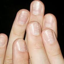 Simple Tips For White Spotted Nail Care White Spots On Nails Nail Care Tips Nail Care