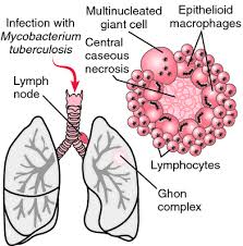 Туберкулез кожи индуративный (tuberculosis cutis indurativa). Miliary Tb Definition Of Miliary Tb By Medical Dictionary