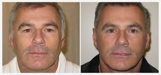 More And More Male Patients Are Seeking Out Anti Aging Solutions This Patient Underwent Full Face And Neck Lift Surger Eyelid Lift Neck Lift Neck Lift Surgery