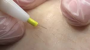 77 likes · 1 talking about this · 2 were here. Electrolysis Hair Removal Youtube