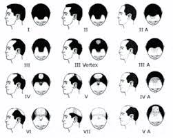 Before and after transplant of 1200 grafts using fue method. Stages Of Male Pattern Hair Loss
