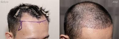 Jun 08, 2021 · gegen schimmelflecken werden allerlei hausmittel empfohlen. Preis Fur Eine Fue Haartransplantation In Der Turkei Besteklinik Com