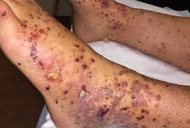 Image result for Vasculitis