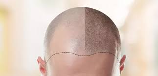 This is because male hair loss is primarily caused by dihydrotestosterone, or dht — a male sex hormone that causes hair follicles to miniaturize and stop producing new hair. Hair Transplant In Turkey All Inclusive Packages
