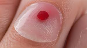 Image result for Akutní zánět nehtového lůžka