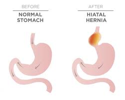 hiatal hernia surgery procedure recovery and outlook