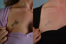 Which could be 6 sessions or 8 sessions. Roland Laser Tattoo Removal Before And After Gallery
