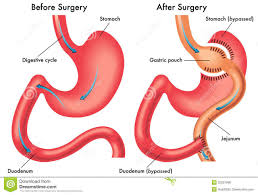 Pin On Weight Loss Surgery In Delhi