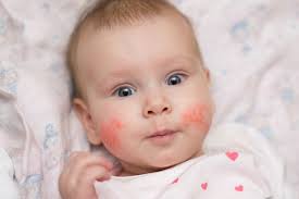 Ubat eczema, ubat eczema baby, ubat eczema dengan, ubat sapu tahan lama, ubat sapu sakit lutut, ubat sapu gatal, ubat sapu dan ubat selsema untuk ibu yang menyusu. Rekomendasi 5 Obat Eksim Alami Yang Aman Untuk Bayi Bukareview