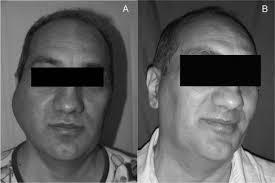Make sure you talk with your vet about what may happen to your dog before they begin chemo. An Unusual Cause Of Facial Swelling Primary Extranodalnon Hodgkin Lymphoma Of The Masseter Muscle The American Journal Of The Medical Sciences