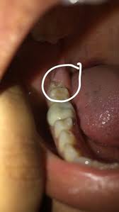 Typically, your dentist will only recommend wisdom tooth however, it doesn't have to cost that much. Wisdom Teeth Removal Experience Redflagdeals Com Forums