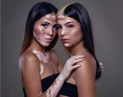 Image result for Vitiligo