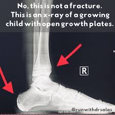 Image result for Growth Plate