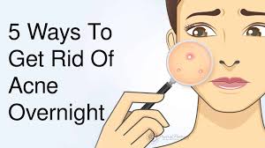 5 Ways To Get Rid Of Acne Overnight