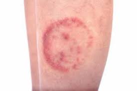 How long is ringworm contagious if treated vs. Is My Rash Ringworm Or Something Else