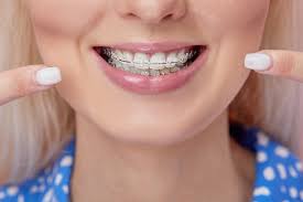 In most instances, the best way to whiten teeth with braces is by following your orthodontist's advice about cleanliness and dental hygiene. Goose Creek Orthodontist Braces Invisalign Kids Braces Charleston